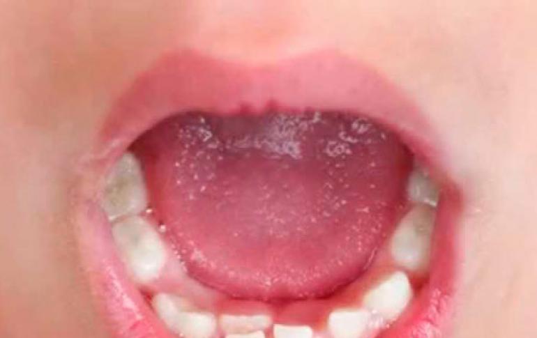 Сверхкомплектные зубы: причины возникновения и способы устранения гипердонтии